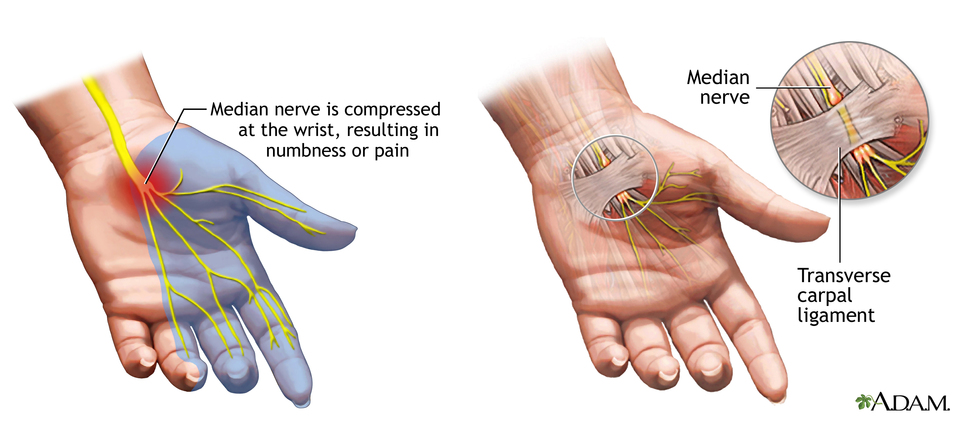 carpal tunnel combo image 970 444 20170215105903