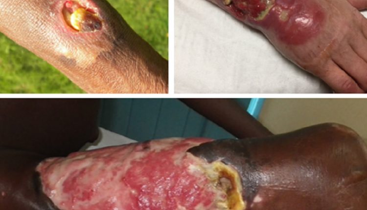 Buruli Ulcer 750x430