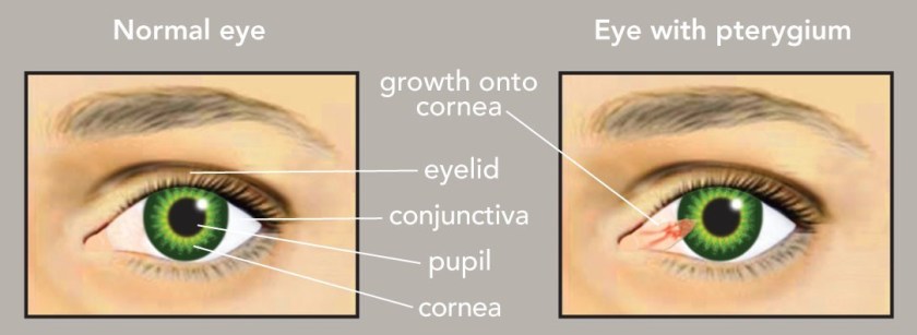 Pterygium 01.jpg.0x605 q90 crop smart