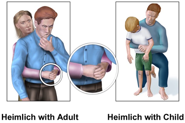 heimlich